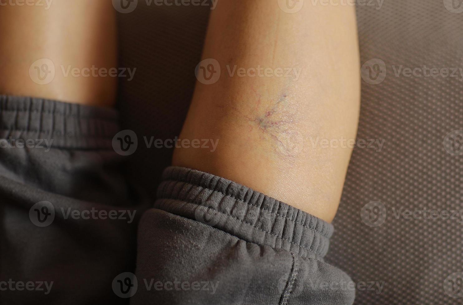 Painful varicose and spider veins on womans legs, who is active at home. Two active seniors in the background. Vascular disease, varicose veins problems, active life concept. photo