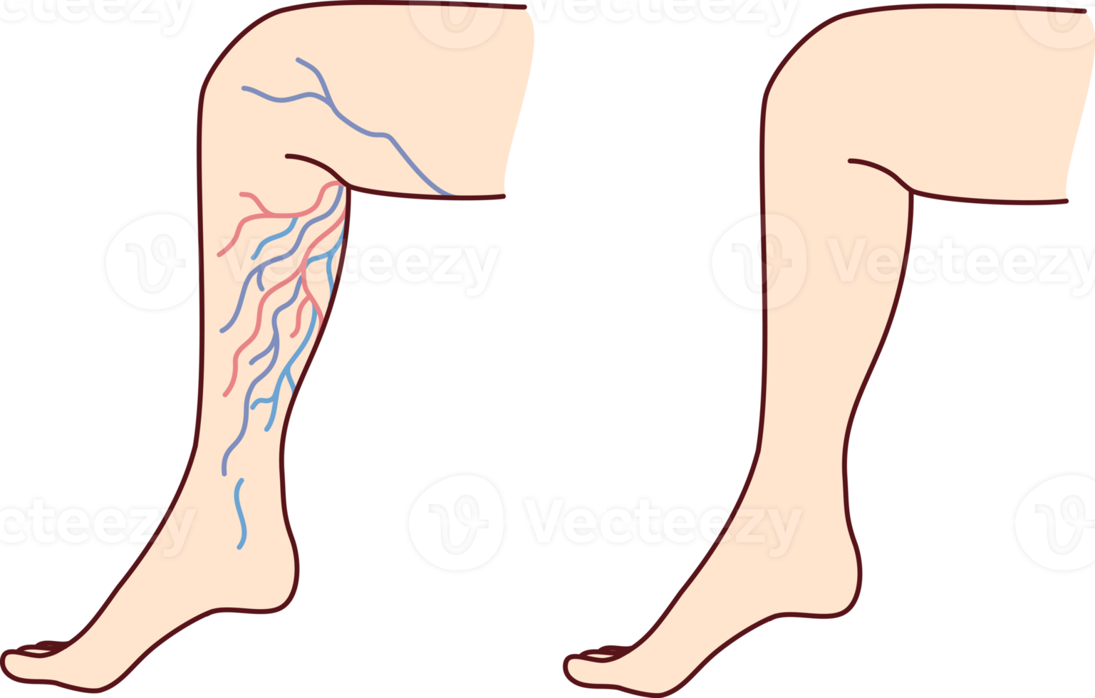 Patient legs with varicose veins png