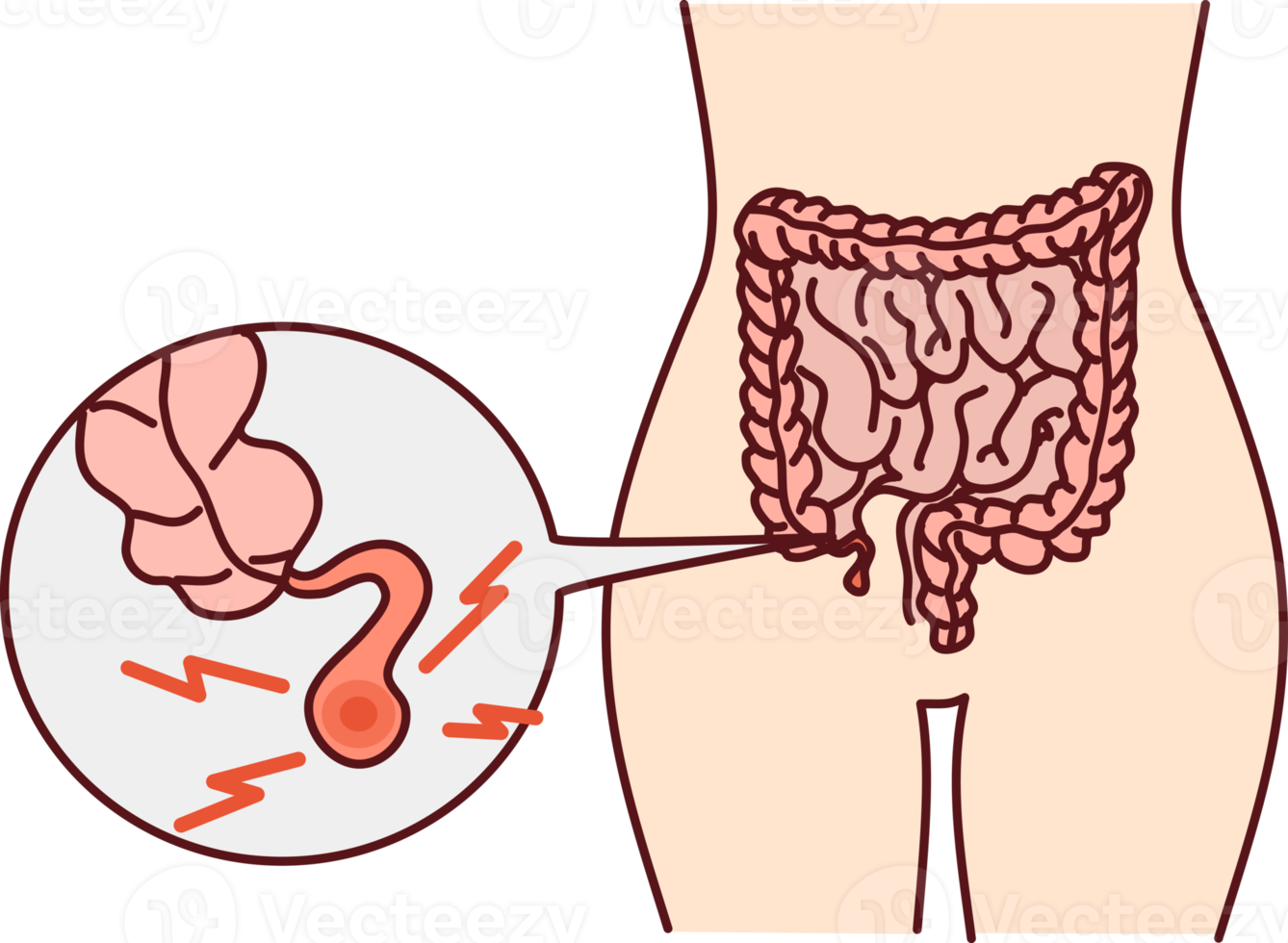 Human body with inflamed appendicitis png