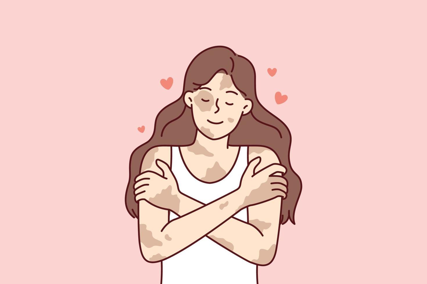Positive girl with vitiligo disease hugging herself taking skin diseases as personal feature. Concepts of body positivity in people suffering from dermatological illness or vitiligo syndrome vector