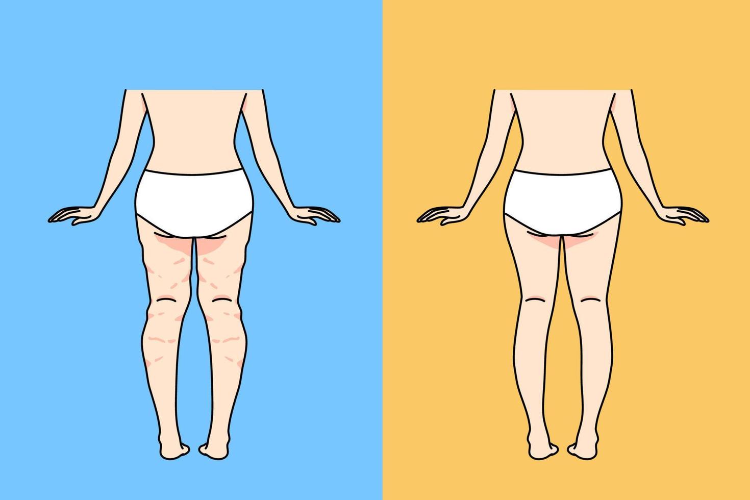 espalda ver de mujer en ropa interior antes de y después celulitis eliminación. hembra inferior cuerpo piernas y culo tener anticelulítico procedimiento o tratamiento. cuerpo forma y cuidado de la salud. vector ilustración.