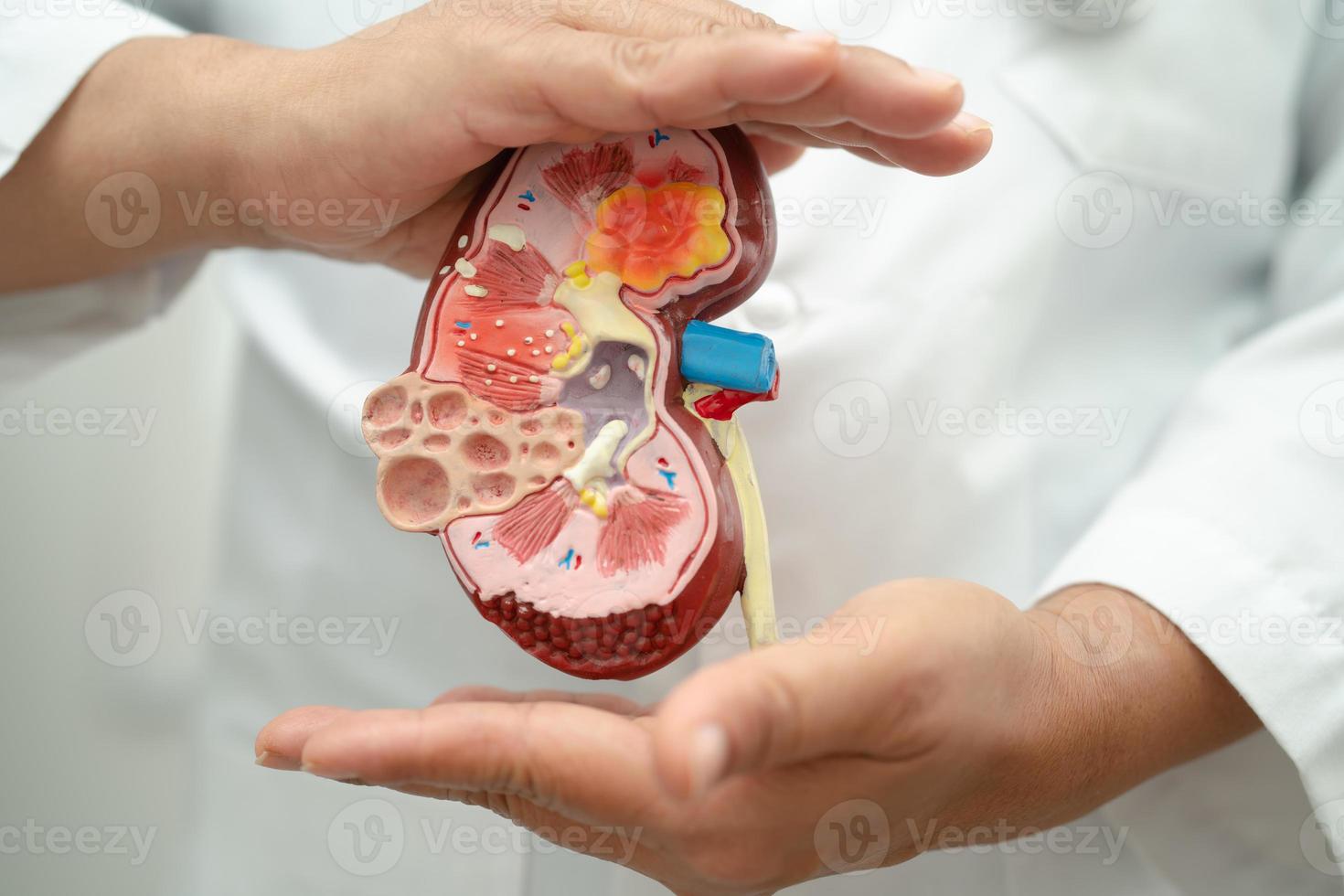 Kidney disease, Chronic kidney disease ckd, Doctor hold model to study and treat in hospital. photo