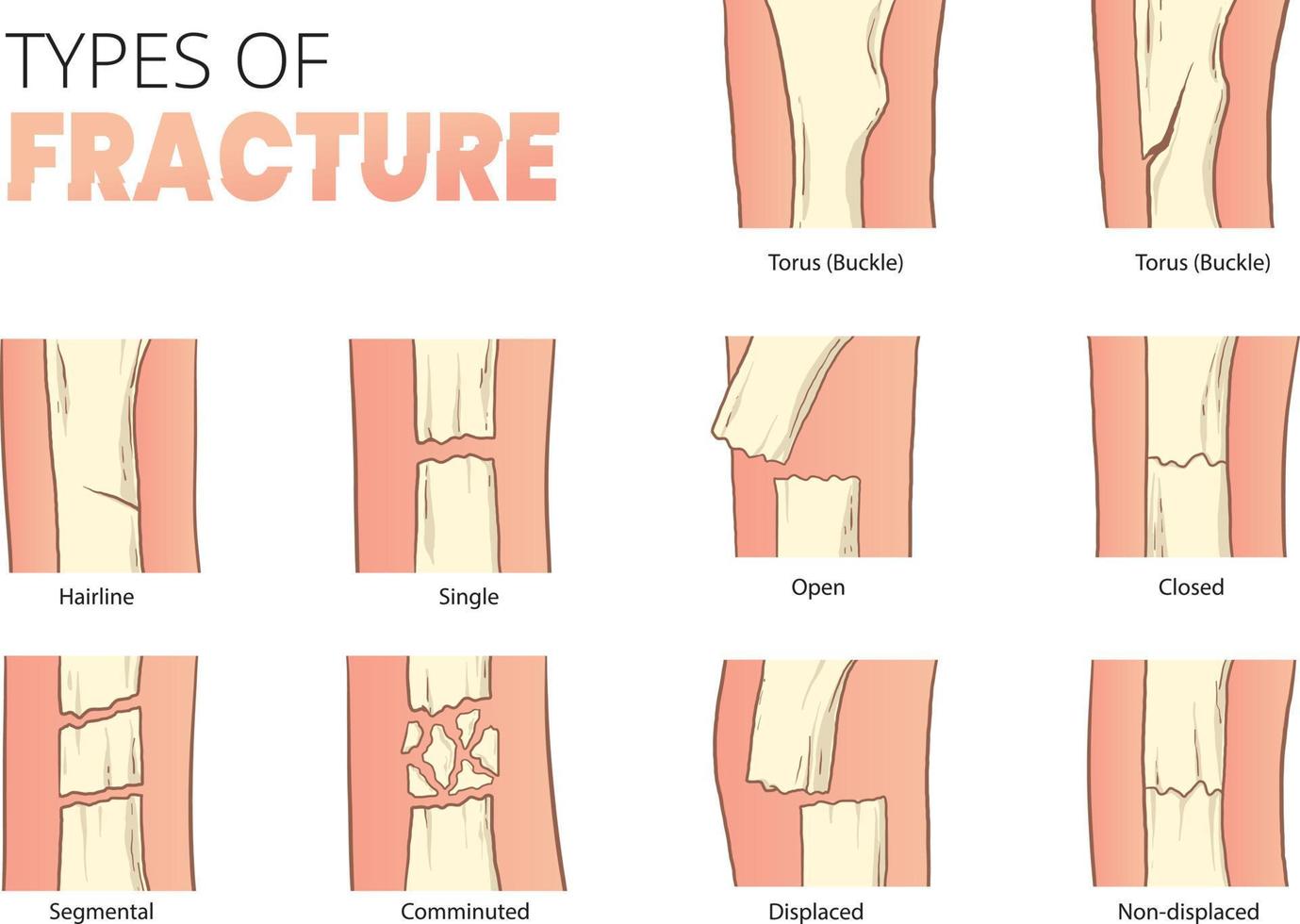 types of bones fracture vector