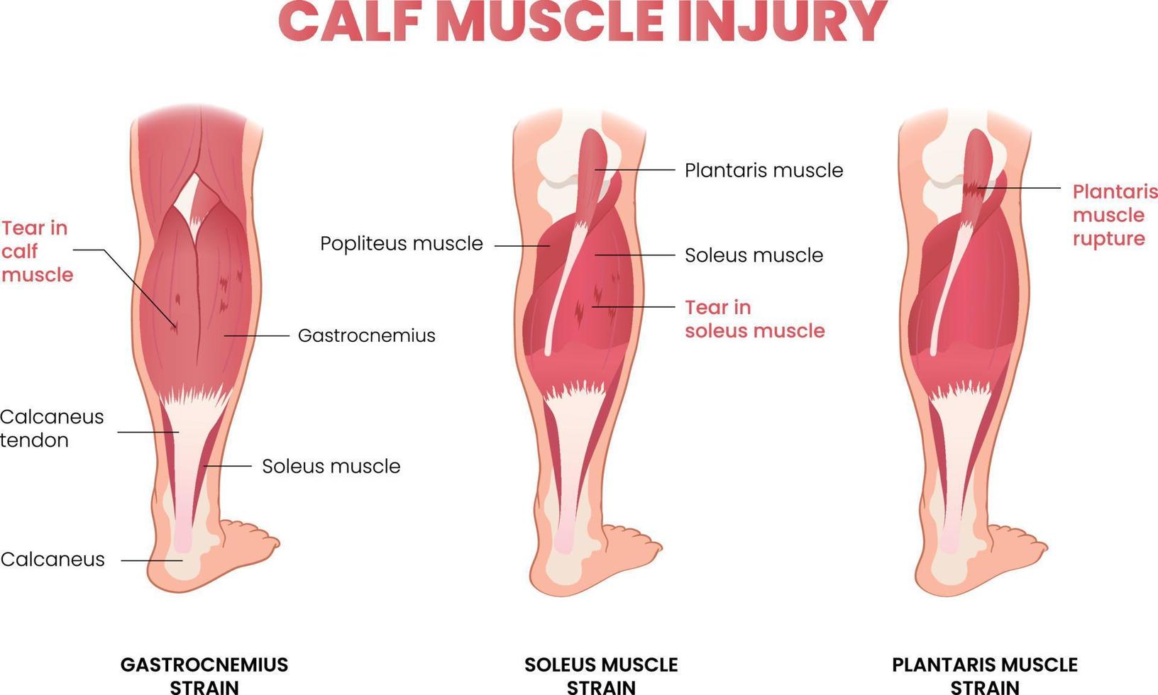 calf muscle injury infographic vector