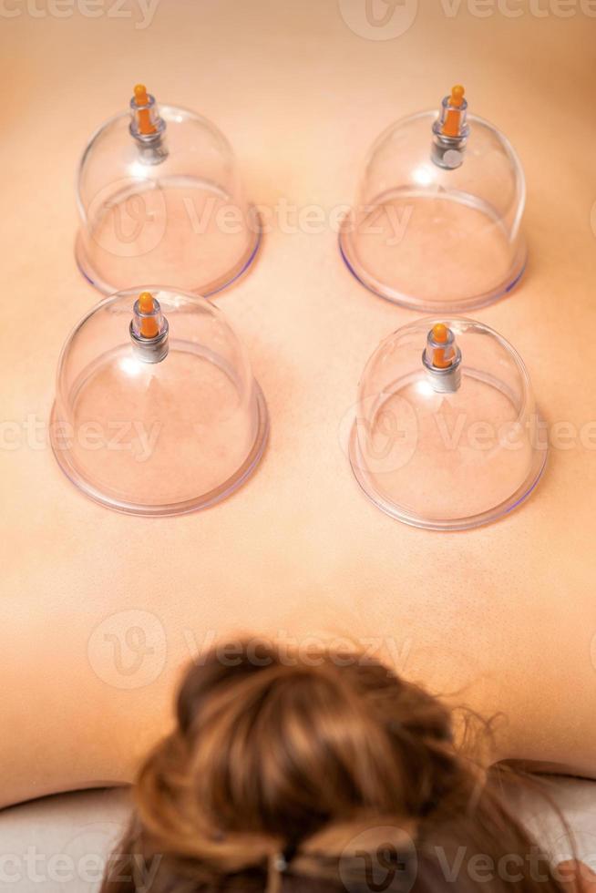 Medical cupping therapy on back photo