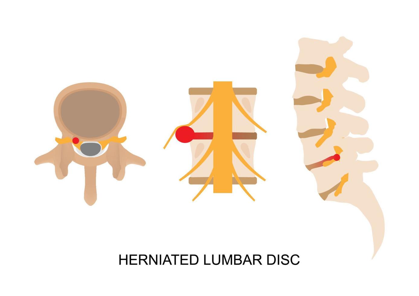 Illustration of herniated lumbar disc in different view. vector