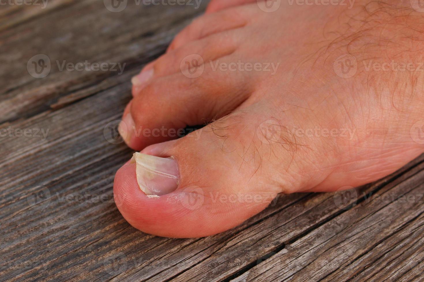 Damaged toenail. The thumb on the man's leg. photo