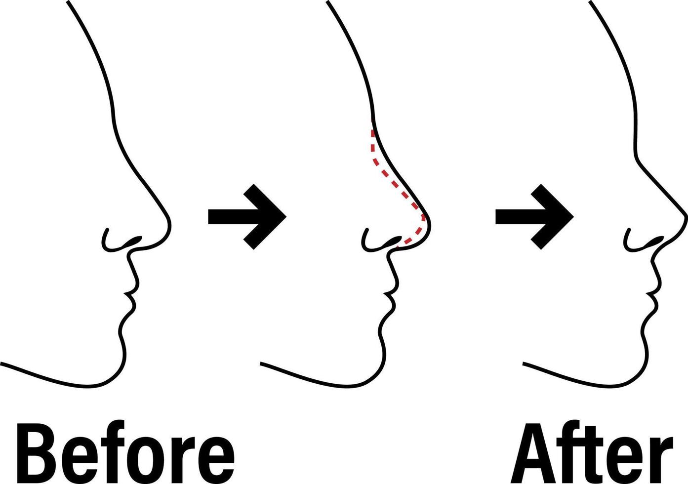 Rhinoplasty before and after the procedure infographics. Nose plastic surgery vector outline concept medical illustration