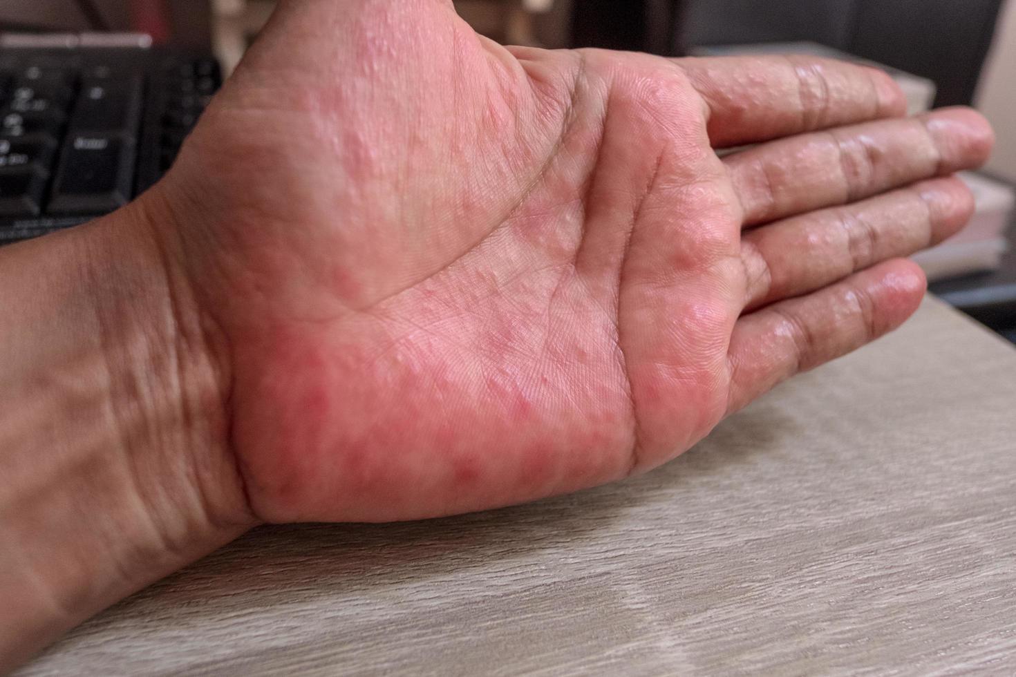 Hands with rash. Red sports on the hand, palm and fingers. photo