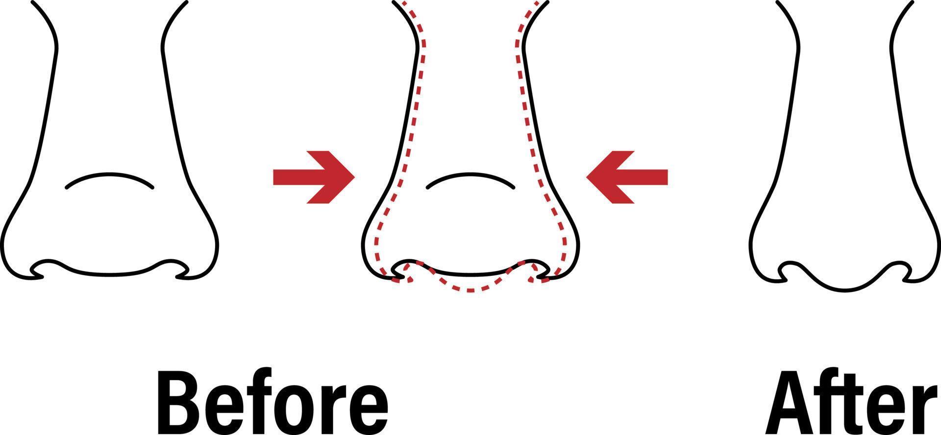 Vector illustration. Front view of a wide human nose before, after aesthetic plastic surgery - rhinoplasty nose job . Close up view. For advertising, medical and beauty publications. EPS 10