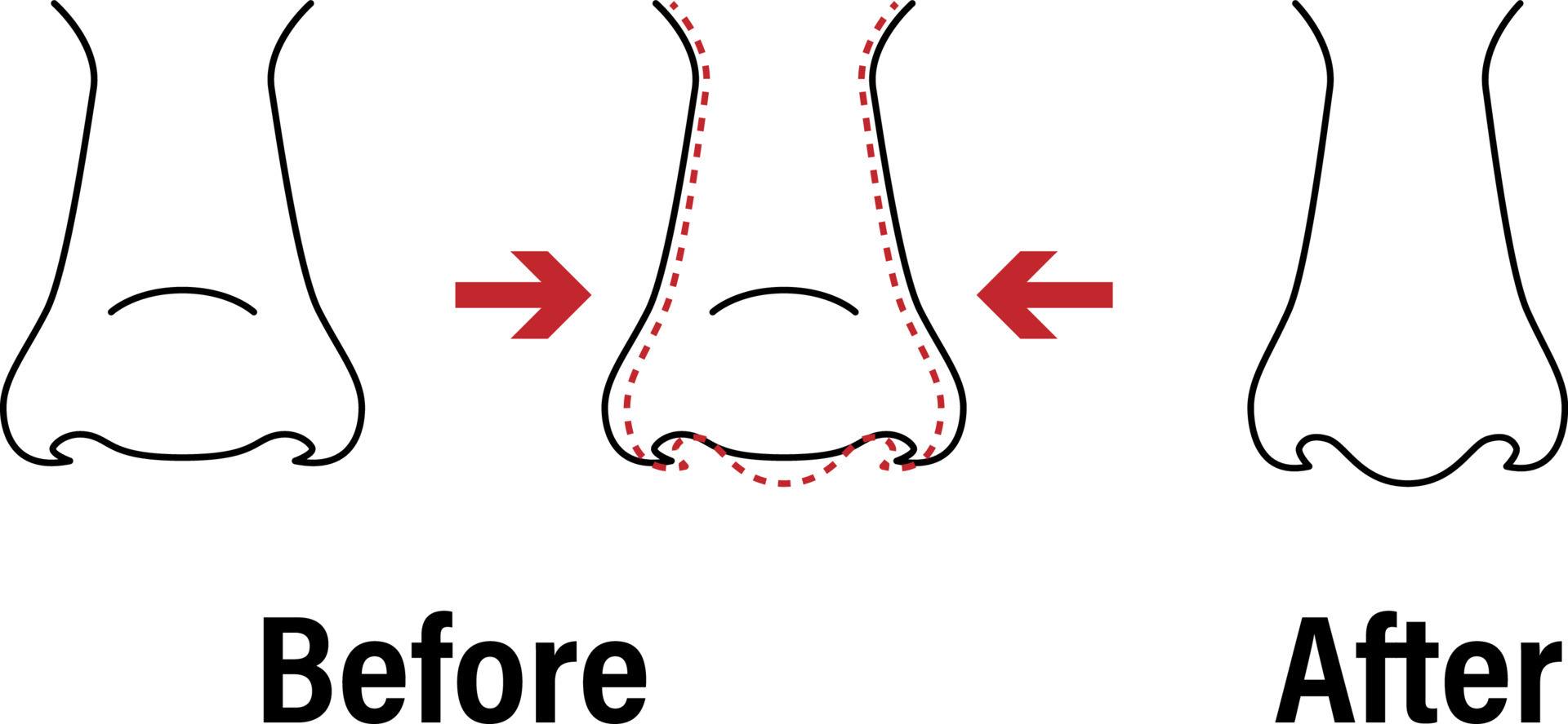 Vector illustration. Front view of a wide human nose before, after