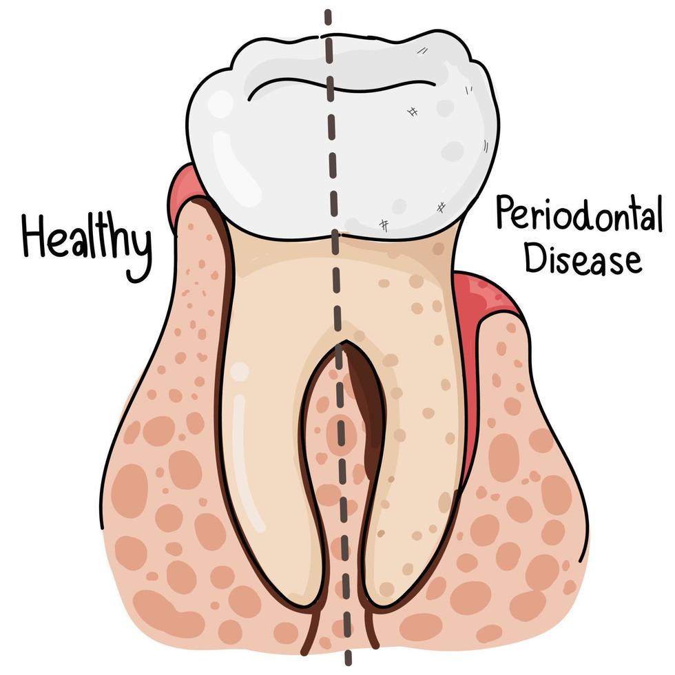 Heathy and Periodontal Disease Teeth Anatomy. vector