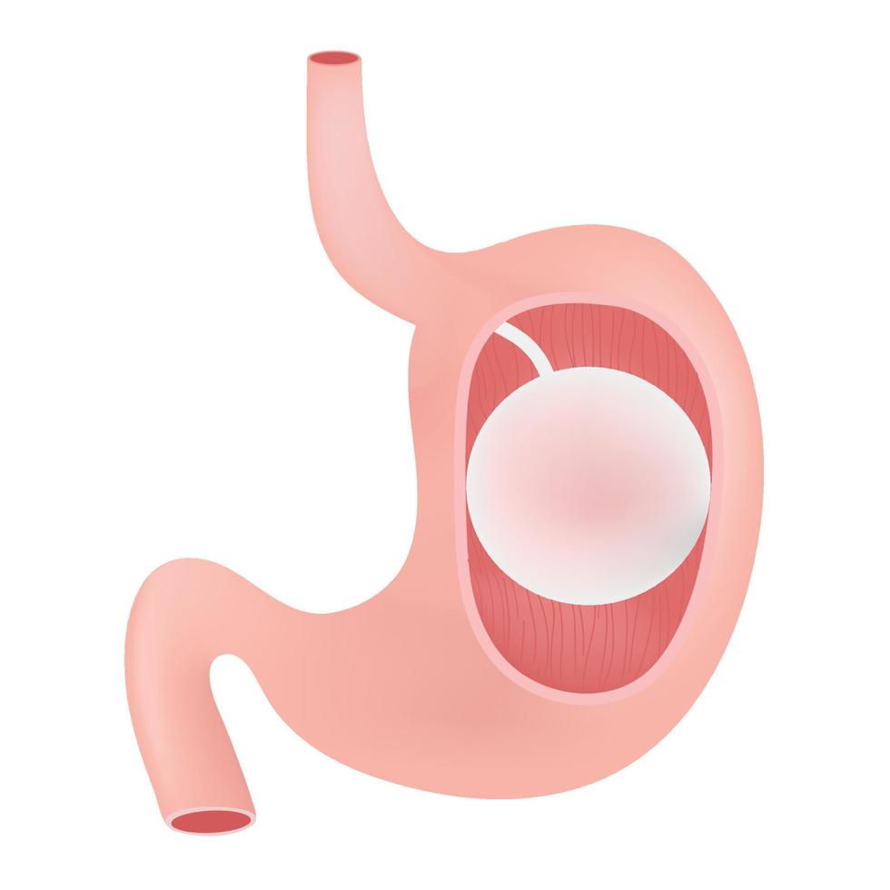 The gastric balloon. vector