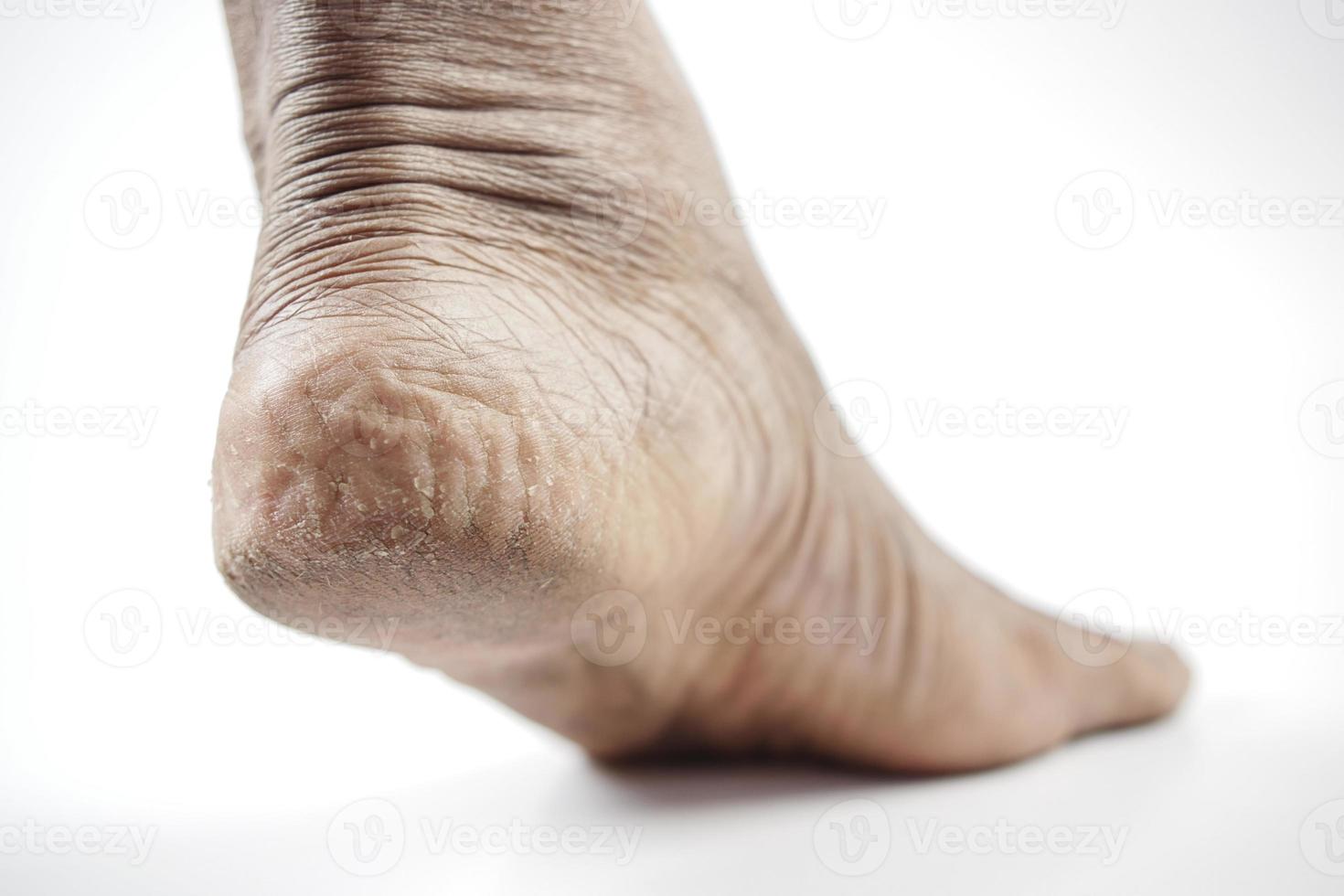 close up of young men dry feet isolated on white photo