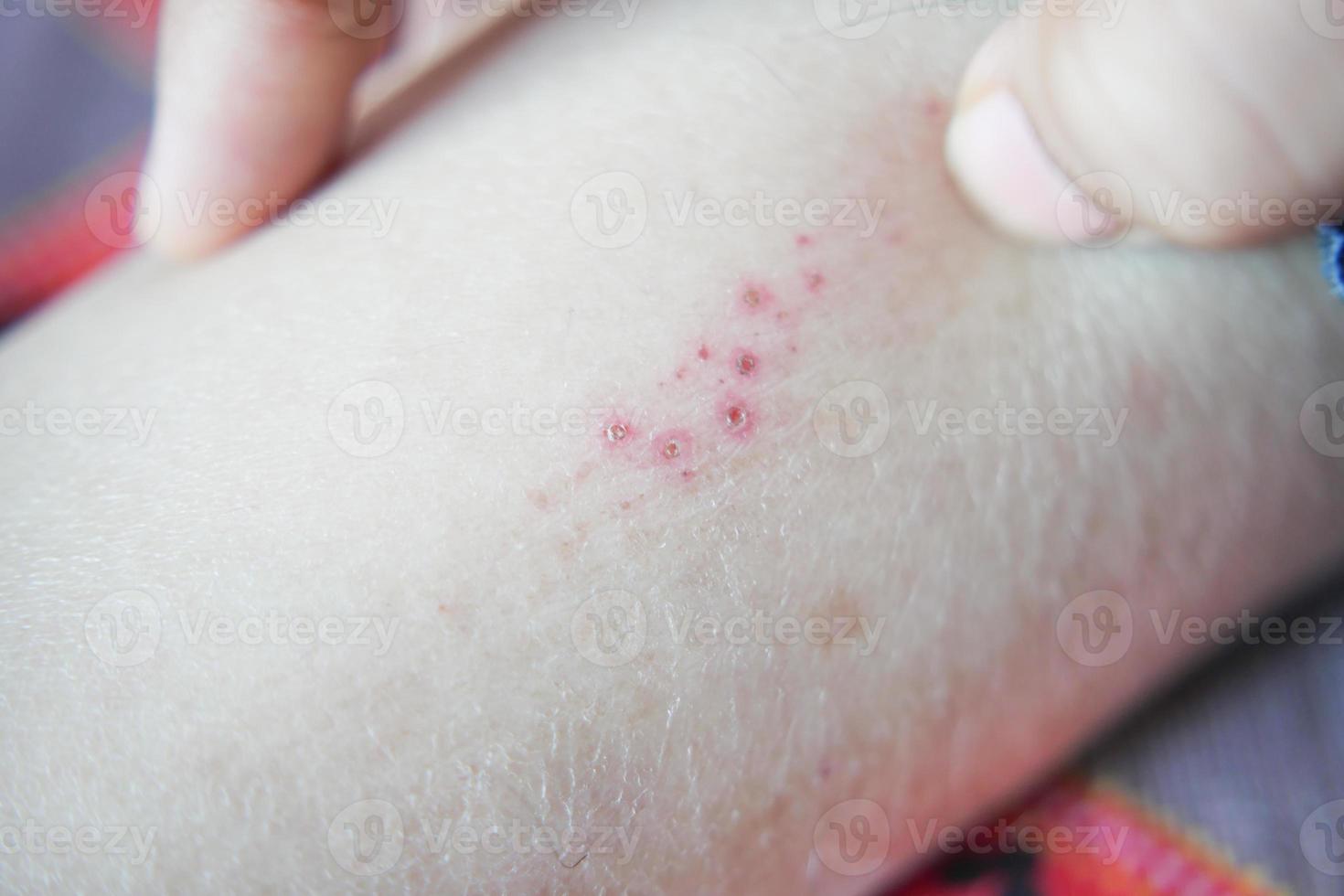 man suffering from itching skin, close up. photo