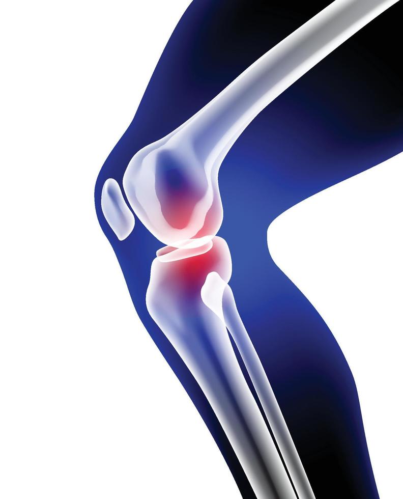 X-ray illustration of leg and knee bone showing pain. vector