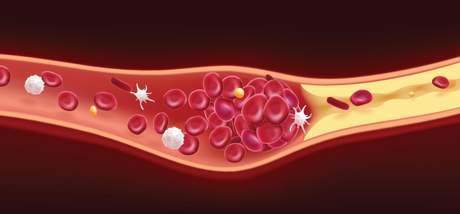 3d ilustración de rojo sangre células y colesterol coágulos porque muerte. vector