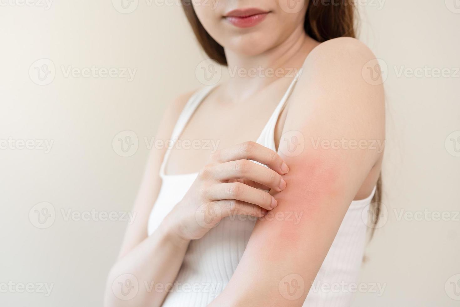 Dermatology, asian young woman, girl allergy, allergic reaction from atopic, insect bites on her arm, hand in scratching itchy, itch red spot or rash of skin. Healthcare, treatment of beauty. photo