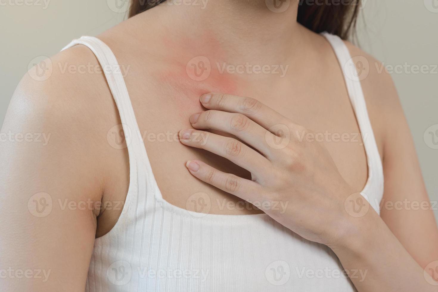 Dermatology, asian young woman, girl allergy, allergic reaction from atopic, insect bites on her body, hand in scratching itchy, itch red spot or rash of skin. Healthcare, treatment of beauty. photo