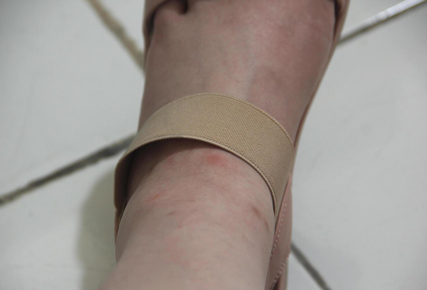 Women leg with brown shoes strap. Visible redness bump scar on skin, need to be treated with ointment. Isolated leg photo on white ceramic floor.