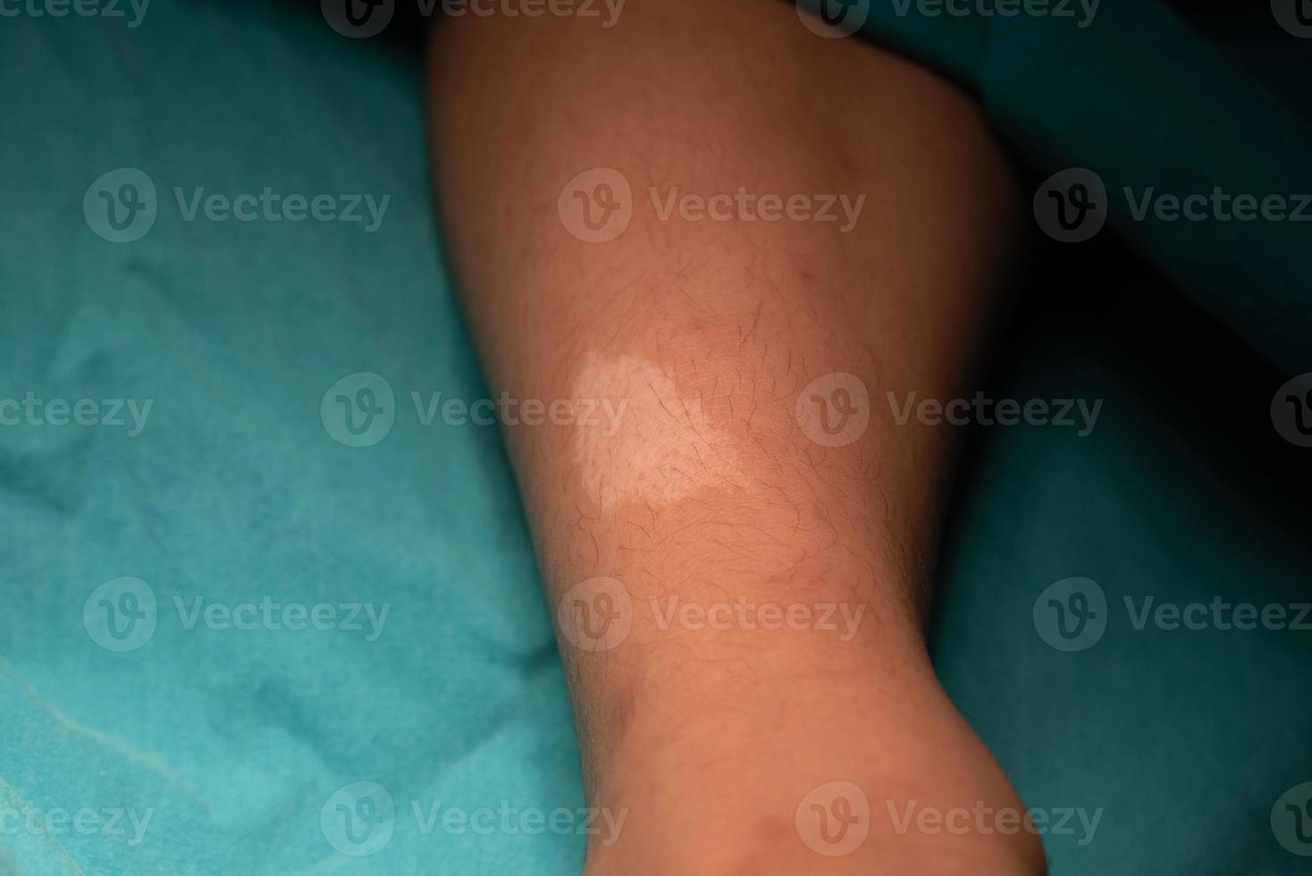 Hypomelanic macules on the leg in tuberous sclerosis patient. photo