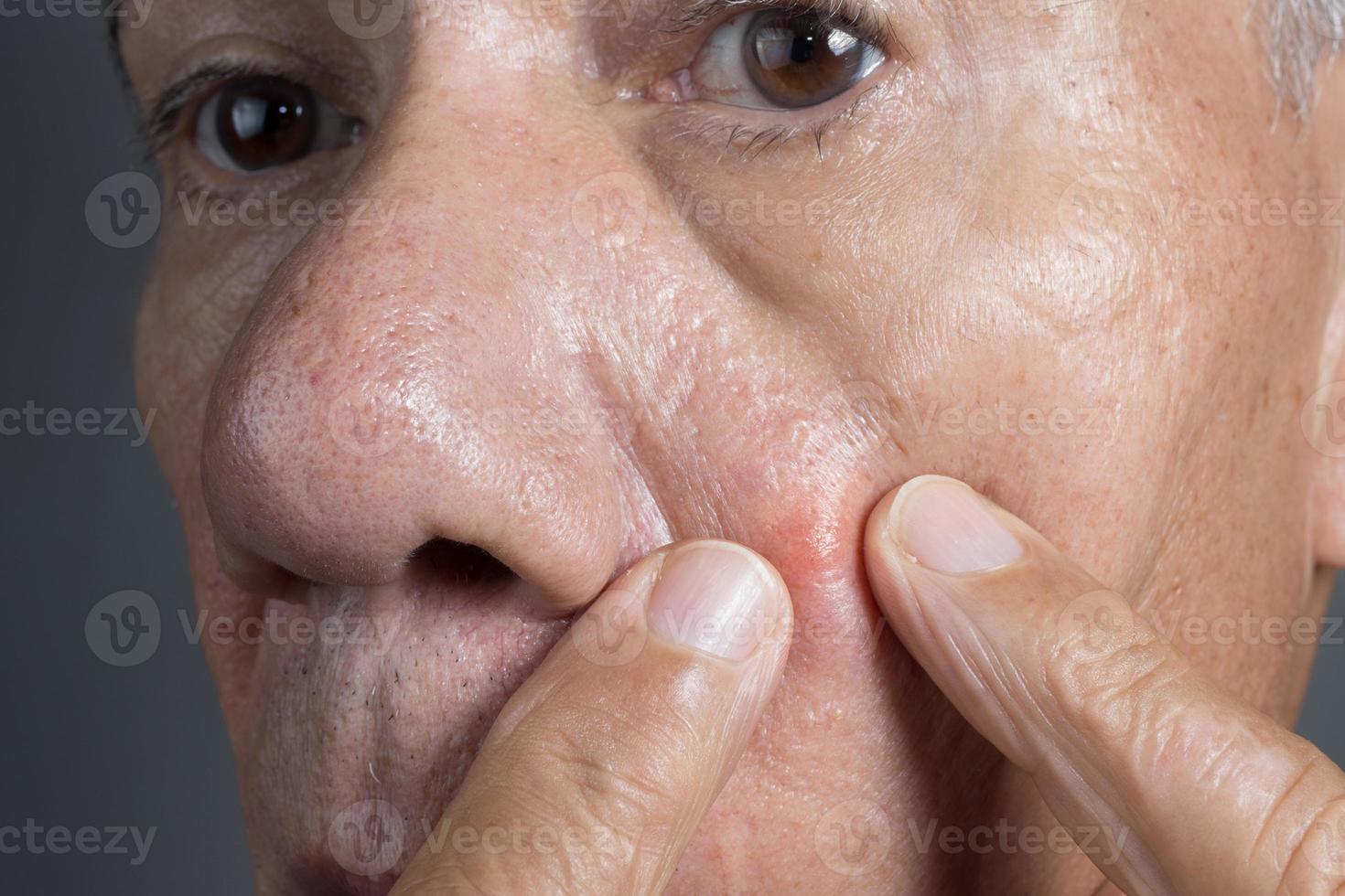 Close up of a Man with a big ugly pimple on his cheek photo