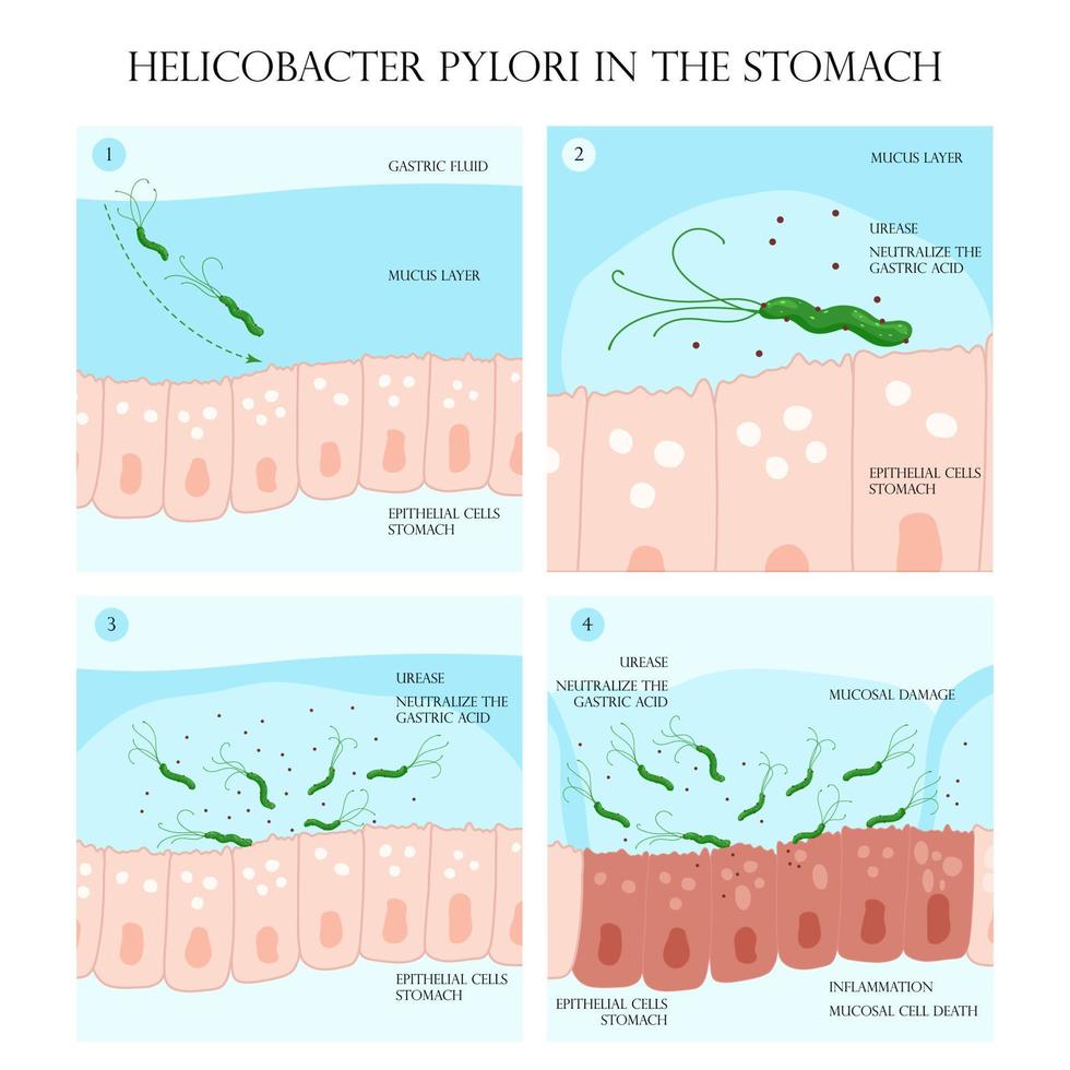 helicobacter pylori infección proceso en estómago mucosa capa ilustración vector