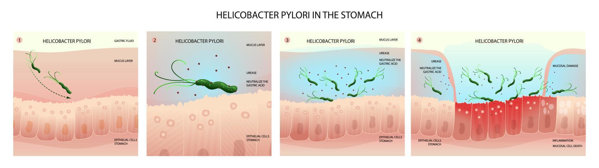 helicobacter pylori en humano estómago, inflamación desarrollo etapas vector