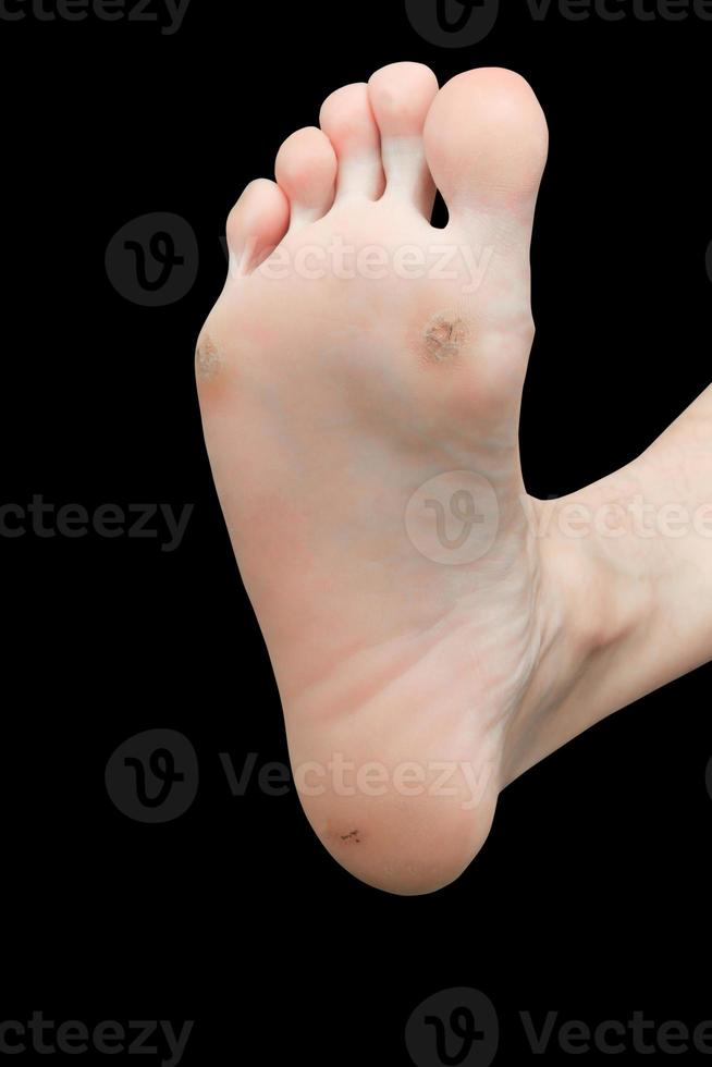 foot corn isolated on black background with clipping path photo