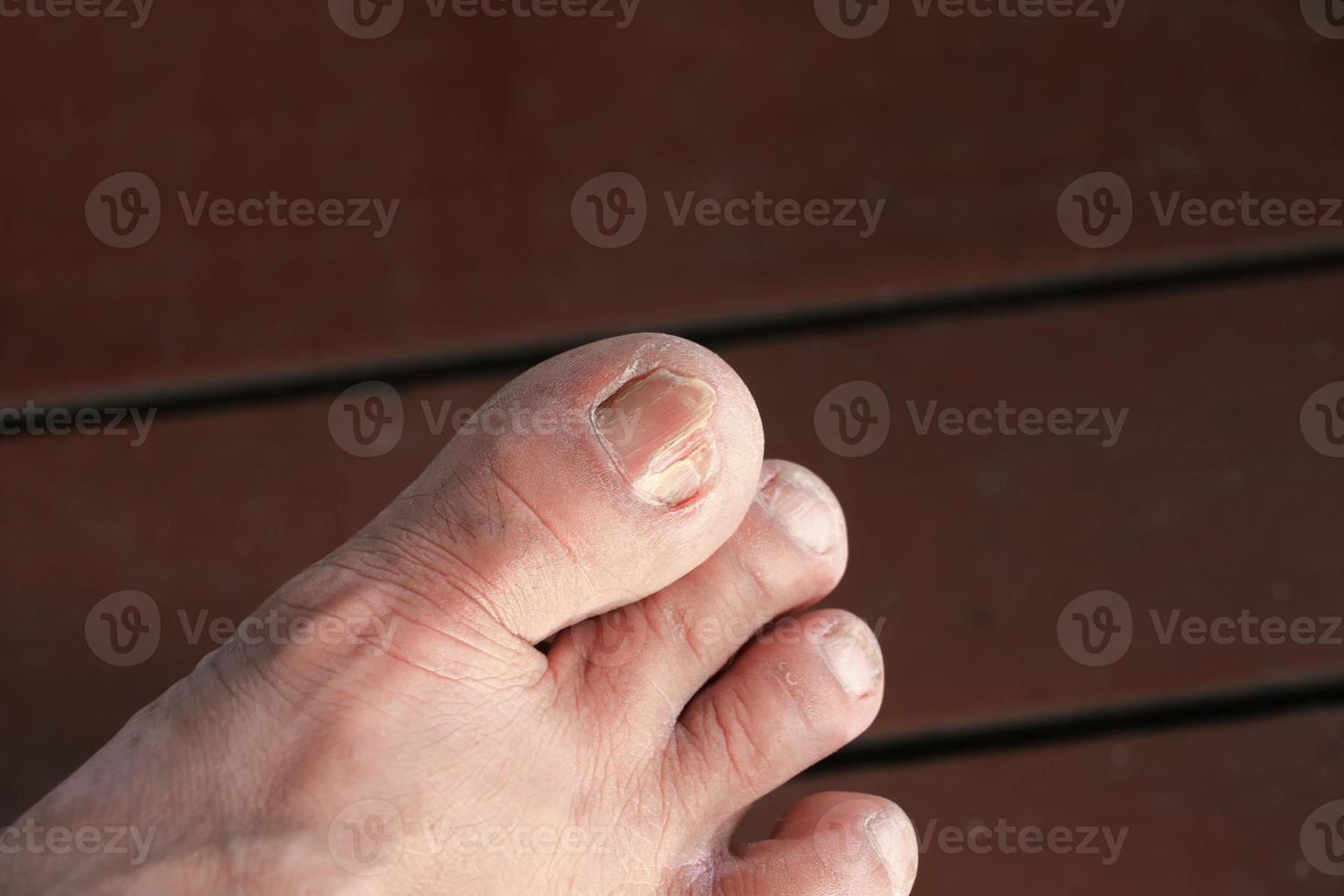 ingrown nail Big toe selective focus, broken toenail on  wood floor with copy space photo