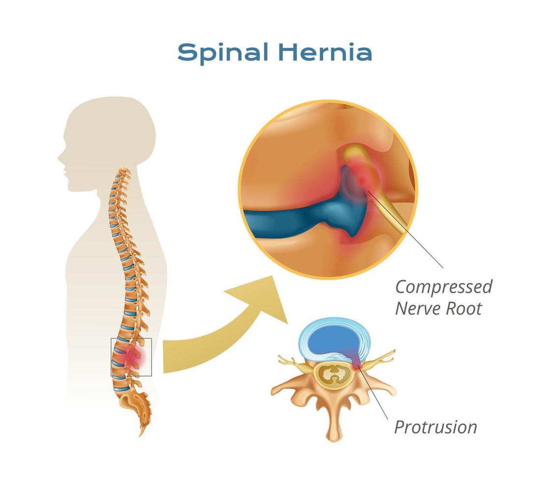 espinal hernia anatomía infografia vector