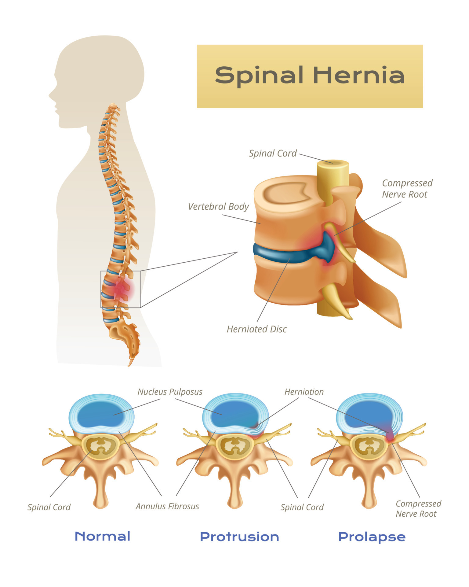 Anatomy Spinal Hernia Infographics 21850610 Vector Art at Vecteezy