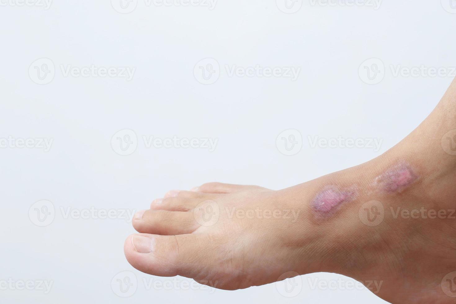 Scars are formed as a result of the process of healing the body's wounds. Whether it is wounds from accidents, surgical wounds or scald burns. photo