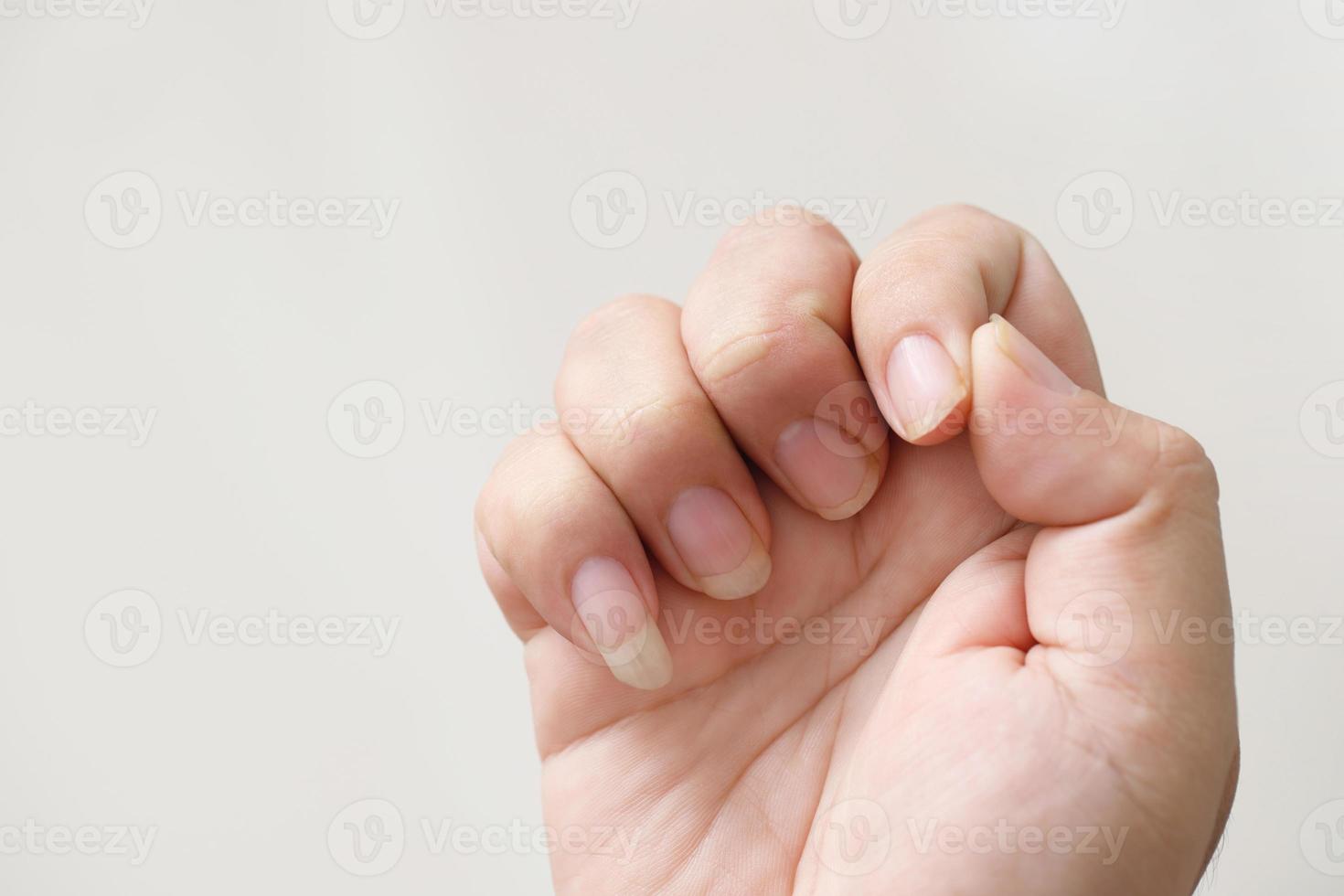 Problems with long, dirty fingernails and bacterial germs photo