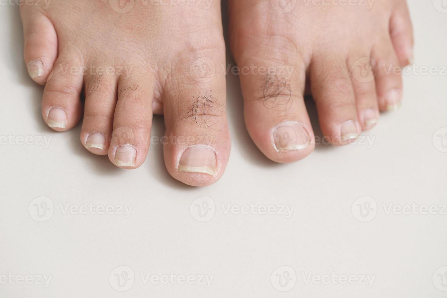 The problem of long, dirty toenails with bacterial germs photo