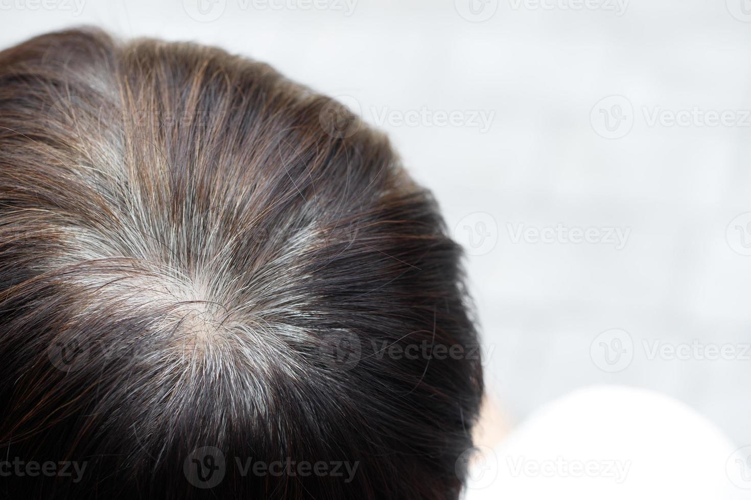 Back view of young people premature gray hair, showing black hoary hair roots on head change to senior old man outdoor. photo