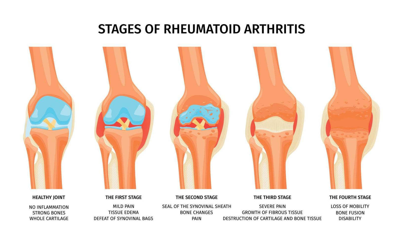 reumatoide artritis etapas infografia vector