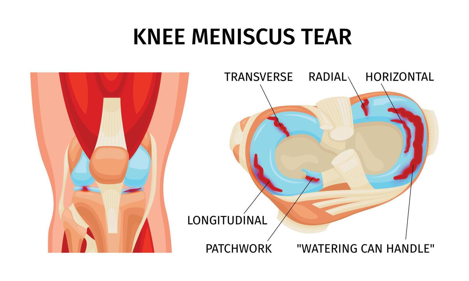 rodilla menisco lágrima infografia vector