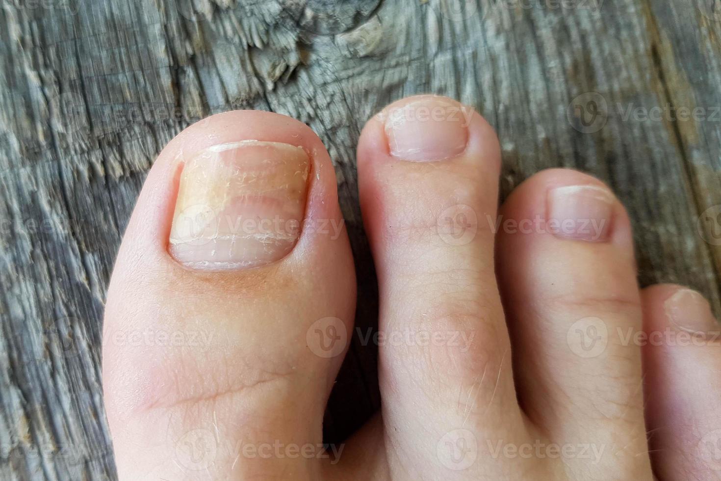 Close-up of a leg with a fungus on nails on a wooden background. photo
