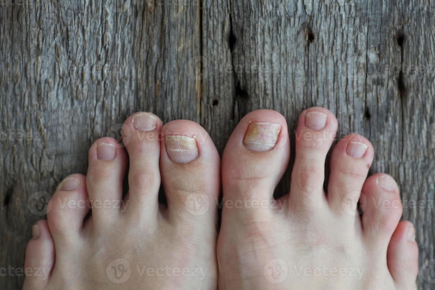Close-up of legs with fungus on nails on wooden background. Onycholysis exfoliation of the nail from the nail bed photo
