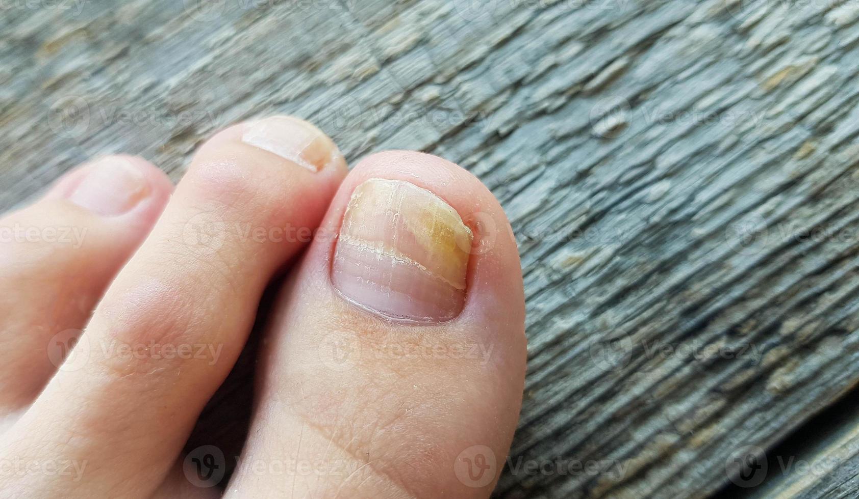 de cerca de un pierna con un hongo en uñas en un de madera antecedentes. foto