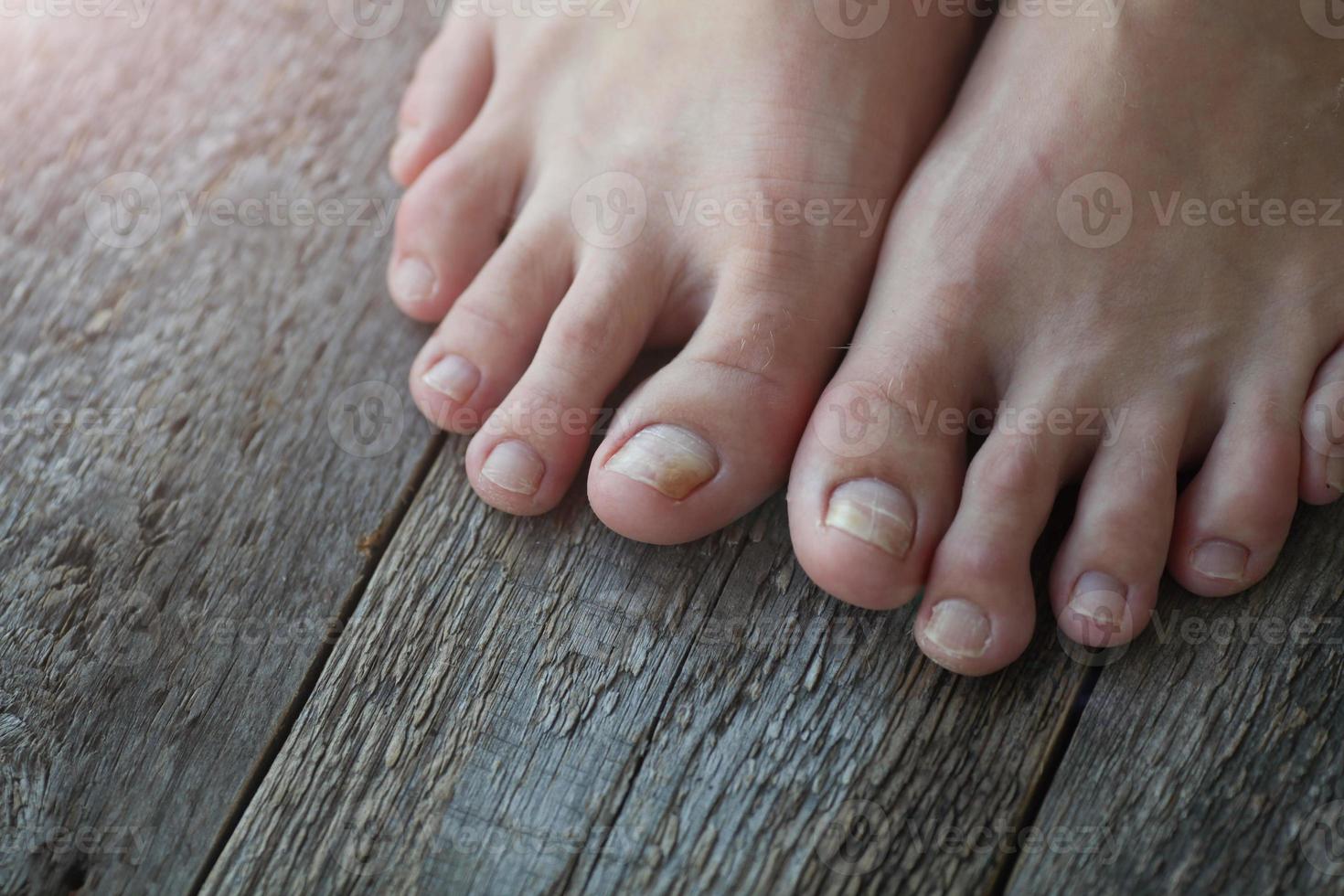 Close-up of legs with fungus on nails on wooden background. photo