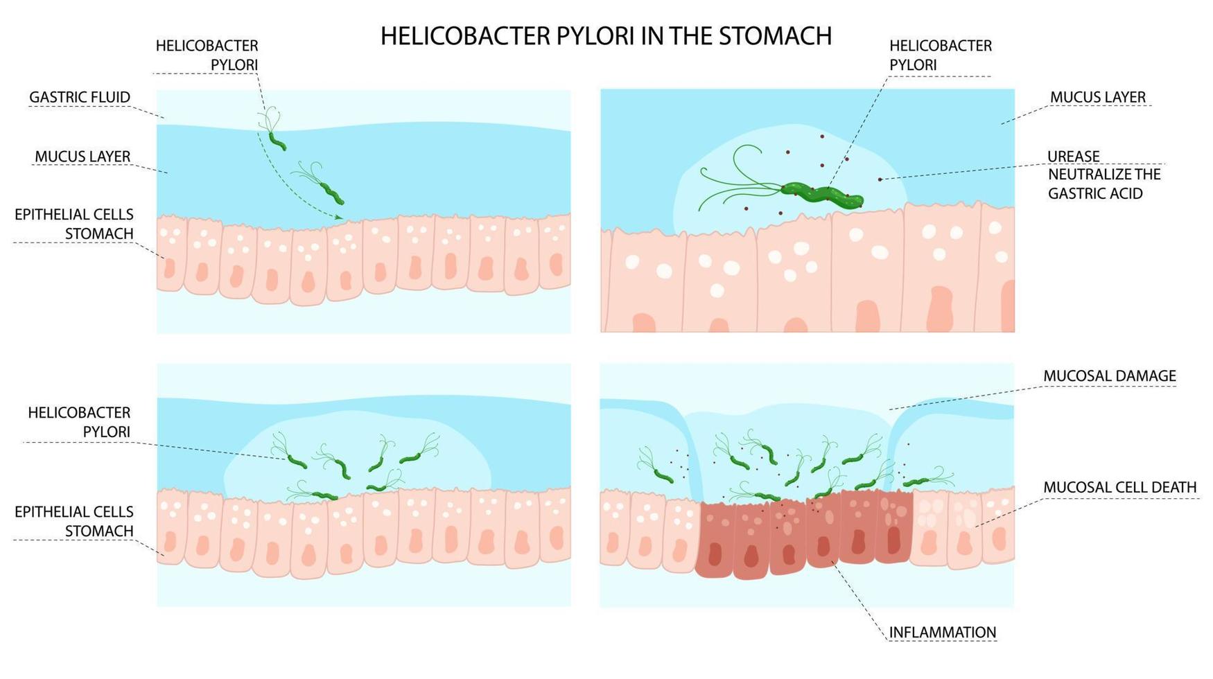 Helicobacter pylori infection process in stomach with inflammation development vector