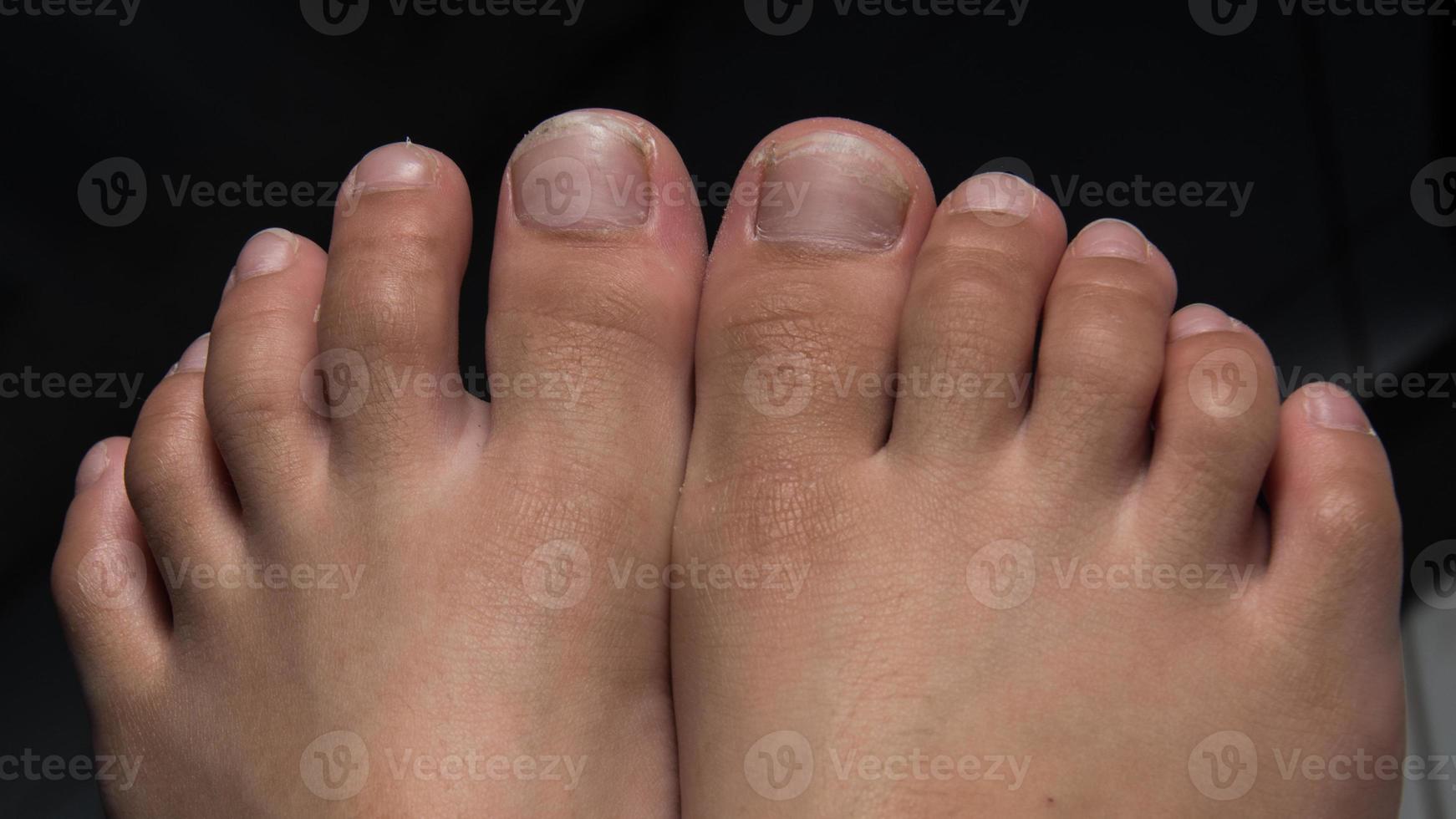 children's toenails are unkempt, long and dirty. photo