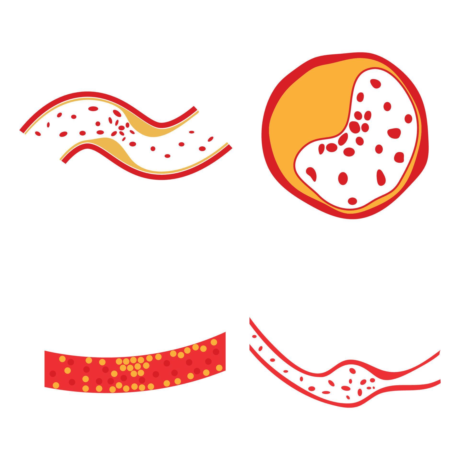 vector of cholesterol plaque 21945197 Vector Art at Vecteezy