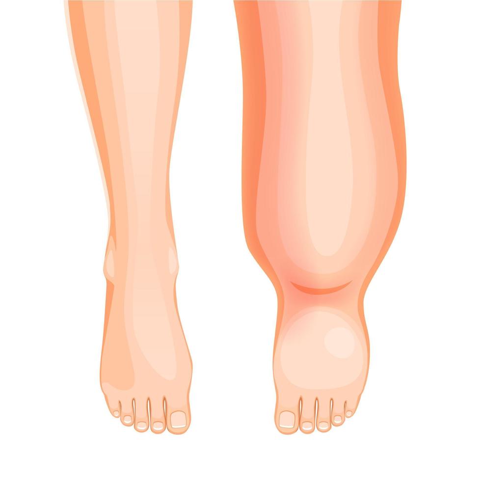 Edema foot disease, swollen leg symptom or problem vector