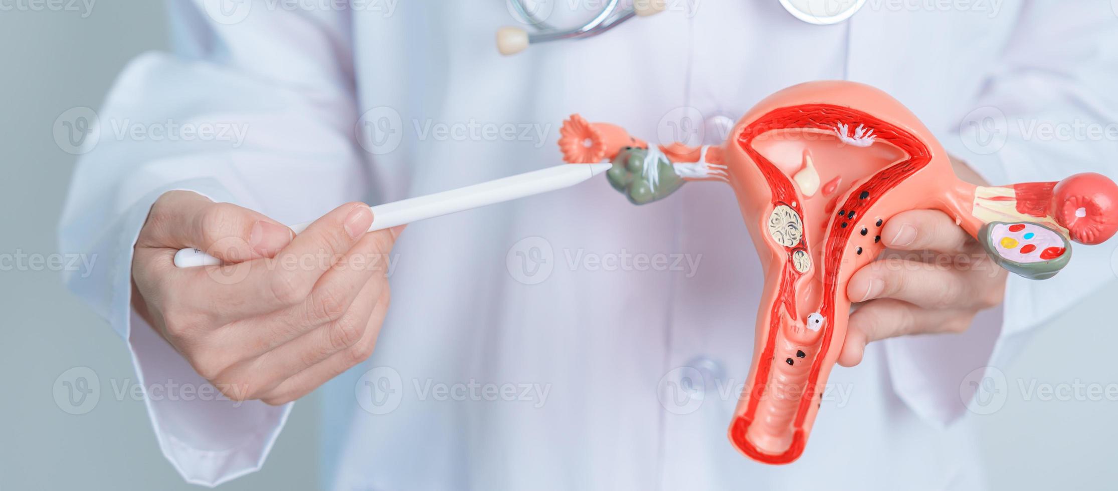 doctor sosteniendo modelo de útero y ovarios. cáncer de ovario y de cuello uterino, trastorno del cuello uterino, endometriosis, histerectomía, fibromas uterinos, sistema reproductivo y concepto de embarazo foto