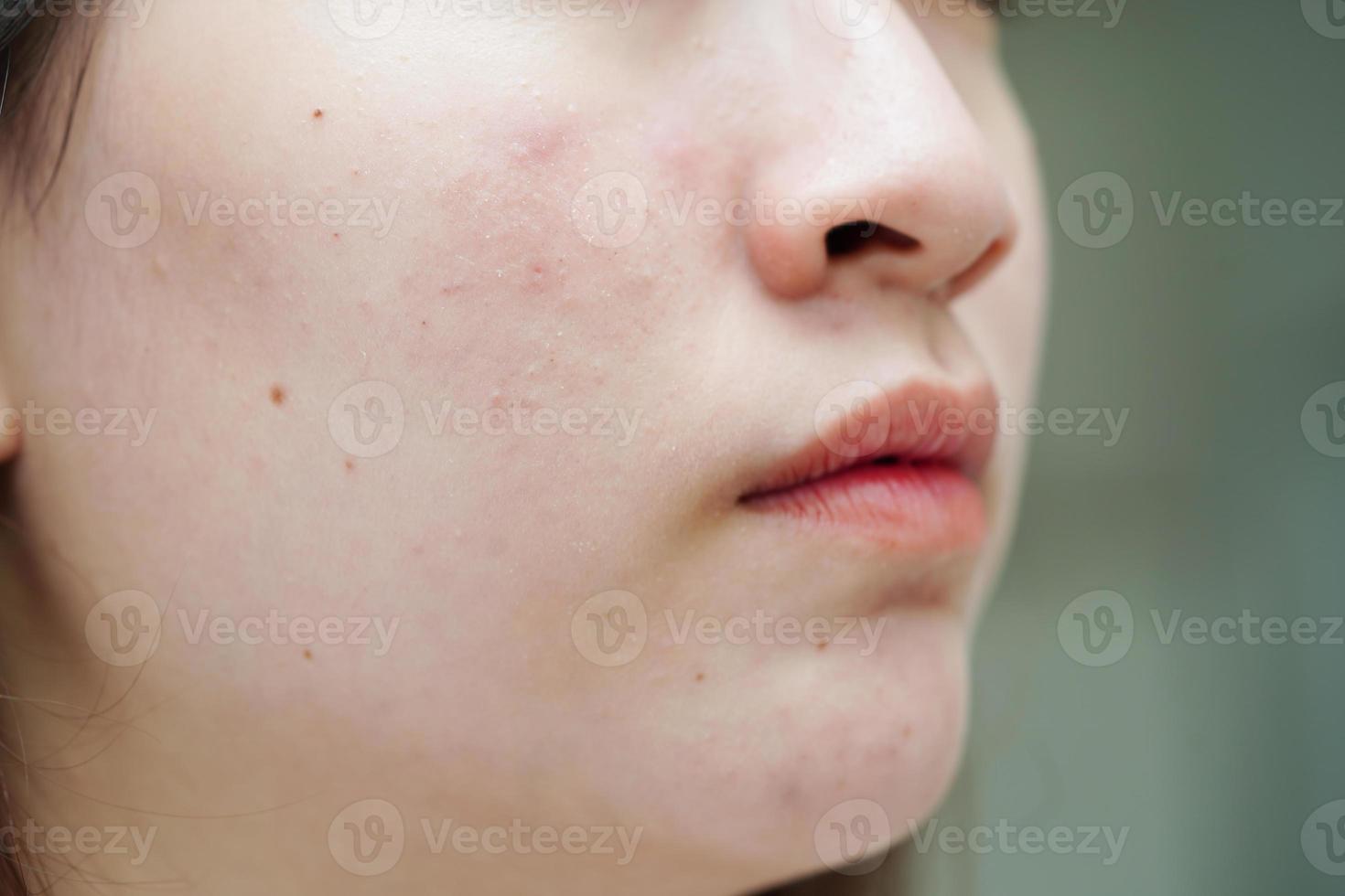 Acne pimple and scar on skin face, disorders of sebaceous glands, teenage girl skincare beauty problem. photo