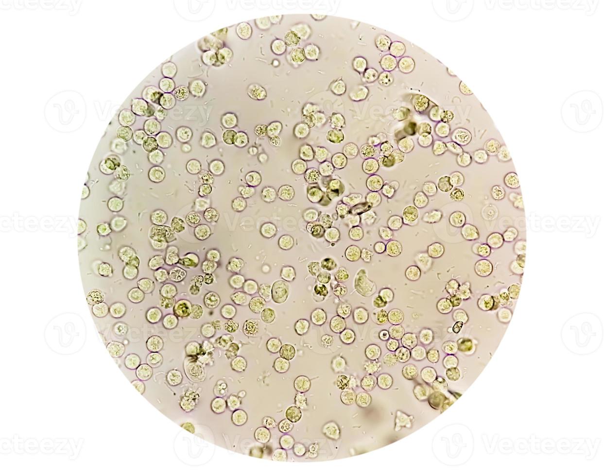 Pyuria or leukocyturia is the condition of urine containing white blood cells or pus. It can be a sign of a bacterial urinary tract infection photo