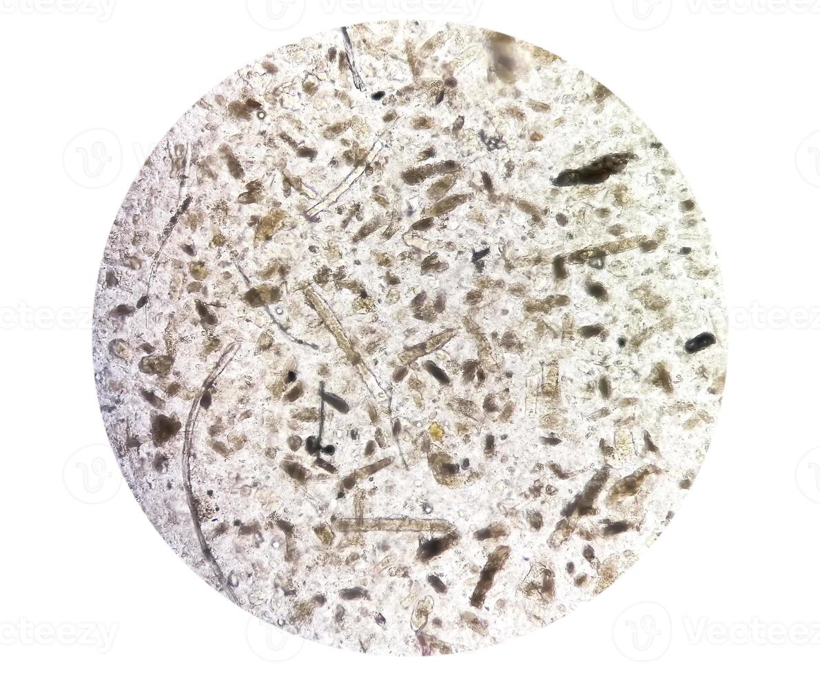 Microscopic urine examination showing Granular cast, a sign of many types of kidney diseases. photo